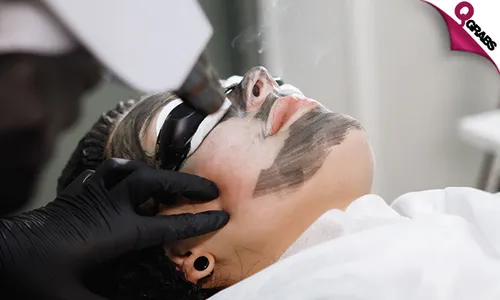 Spectra Carbon Laser Treatment for Face, Underarm & More!